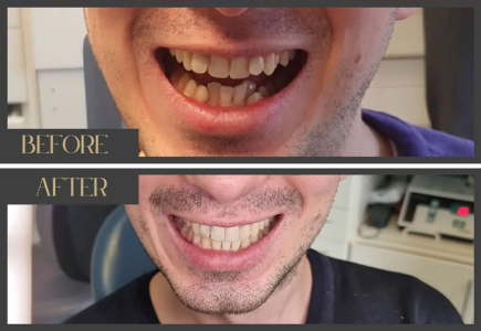 Invisalign Before and After Examples: Real Results & Success Invisalign Before and After Examples: Real Results & Success