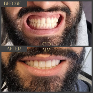 Invisalign Before and After Examples: Real Results & Success Invisalign Before and After Examples: Real Results & Success