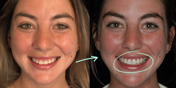 Gummy Smile Treatment | Gum Lift & Contouring Melbourne Gummy Smile Treatment | Gum Lift & Contouring Melbourne